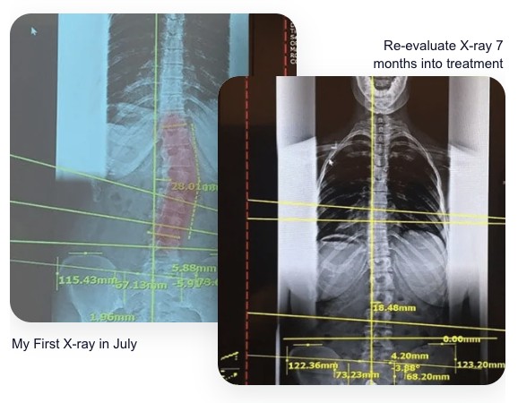 Scoliosis X-ray Before and After Comparison